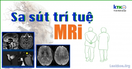 Sa sút trí tuệ - Hình ảnh học cấu trúc giúp chẩn đoán.